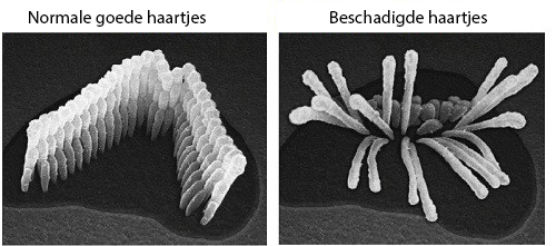 Gezonde en beschadigde haartjes bij tinnitus