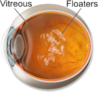 Floaters in het oog