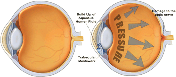Glaucoom en hoge oogdruk