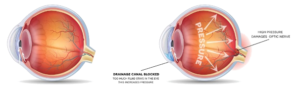 Glaucoom en de oogdruk