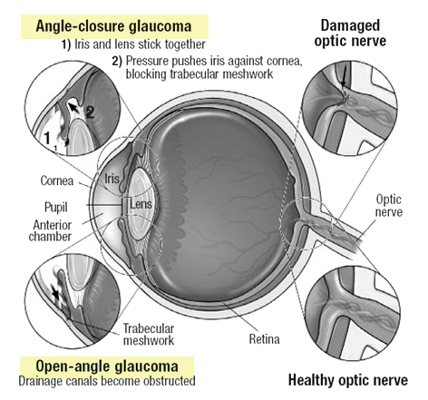 Open en gesloten hoek glaucoom