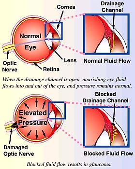 Glaucoom en de oogdruk