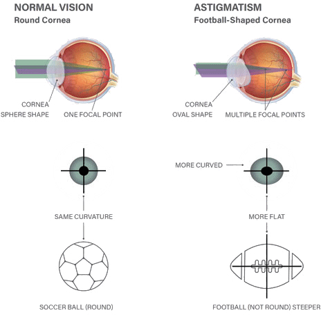 Astigmatisme - Cilindrische afwijking