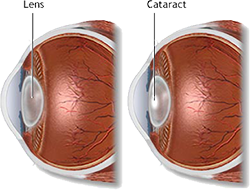 Staar, Cataract