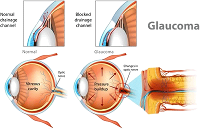 Glaucoom