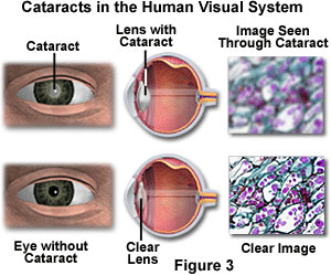 Staar in het oog