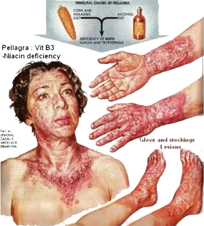 Pellagra, B3 tekort