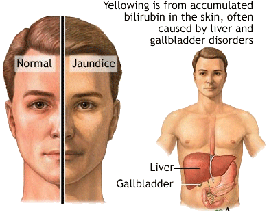 Geelzucht, een lever probleem