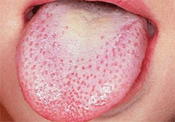 Een beslagen tong: mucus